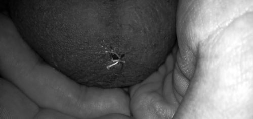 Vasektomie Fäden nach einer Woche